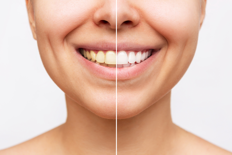 before and after teeth whitening